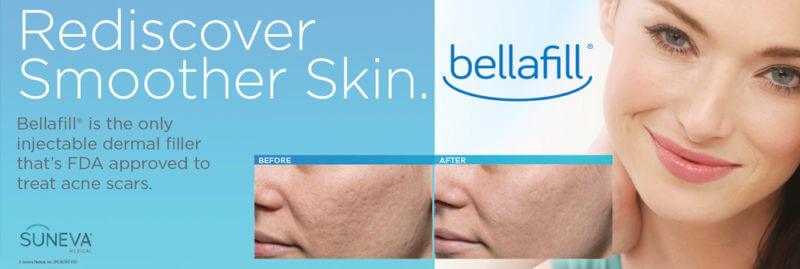 Bellafill Acne Scar Treatment
