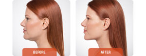 Kybella before and after