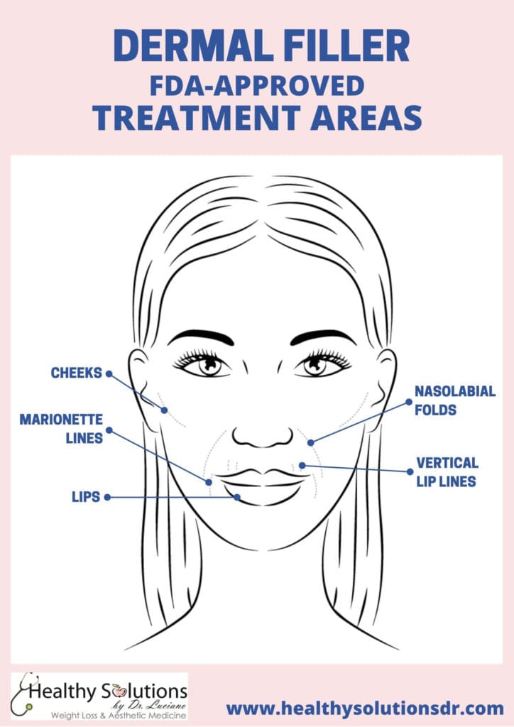 dermal filler treatment areas