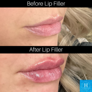 lip filler bucks county pa medspa