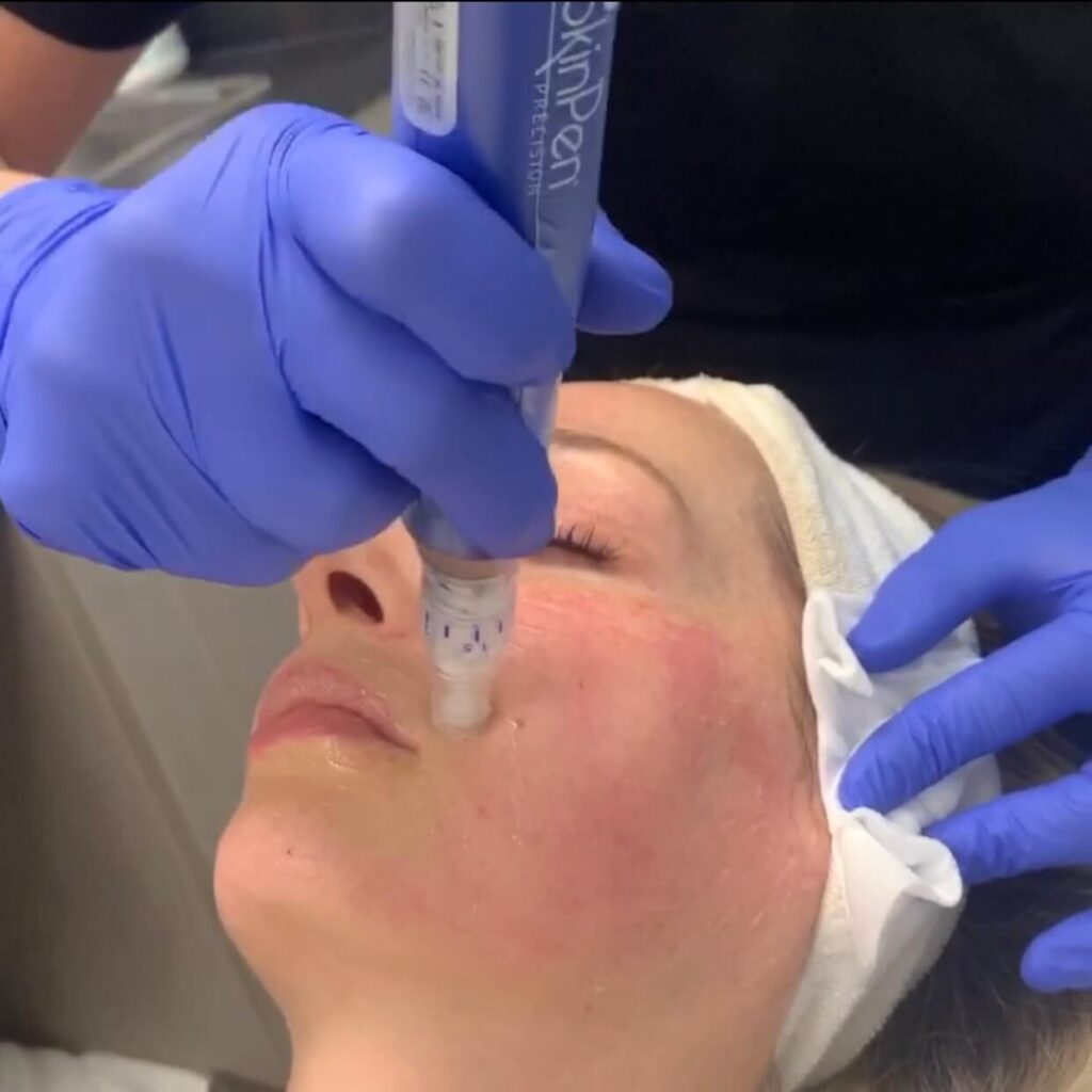 Microneedling near me SkinPen
