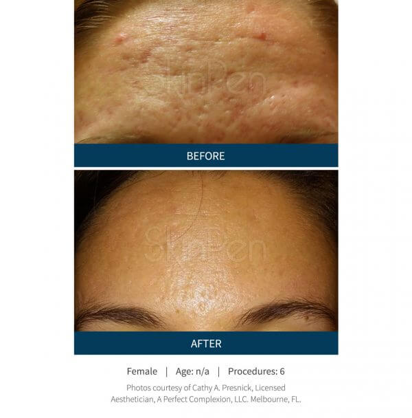 SkinPen Microneedling Bucks County, PA