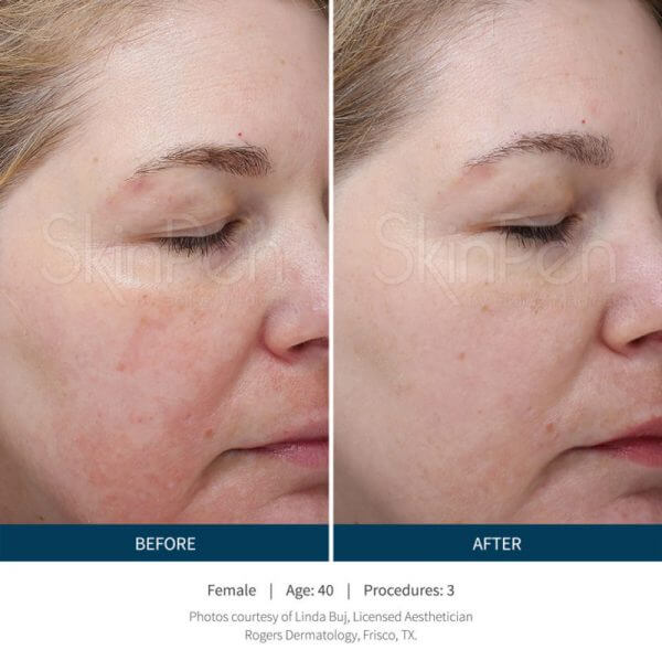microneedling treatment