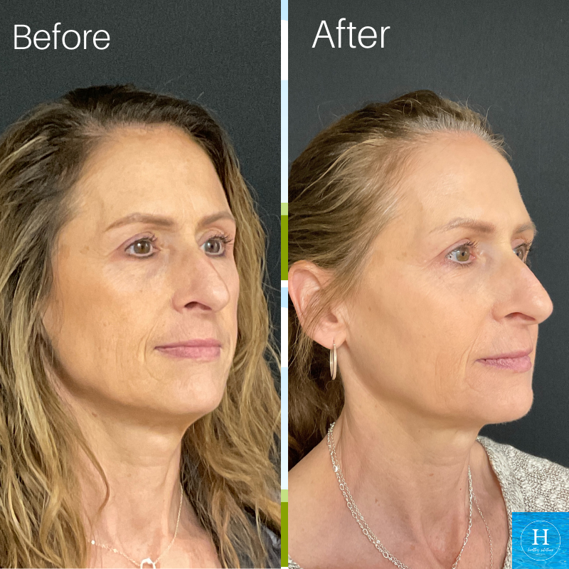 Before & After Juvederm Filler