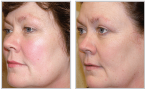 BBL Photofacial Before + After