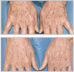 BBL on the hands Before + After