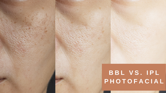 bbl vs ipl photofacial