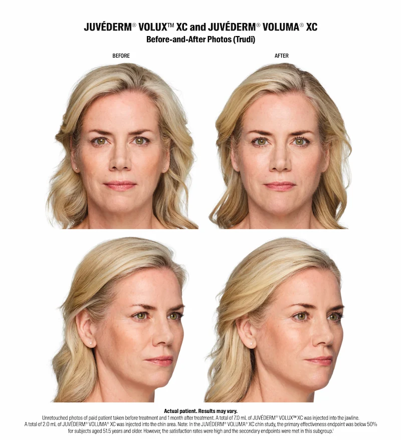 Juvederm before and after photos