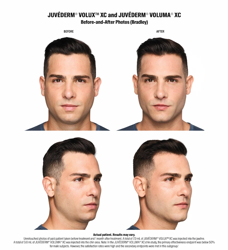 Juvederm before and after photos