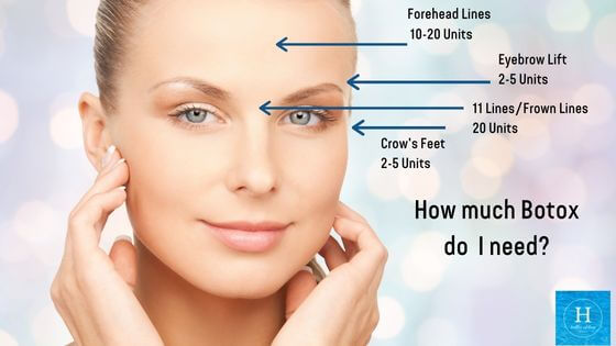How many units of Botox do you need