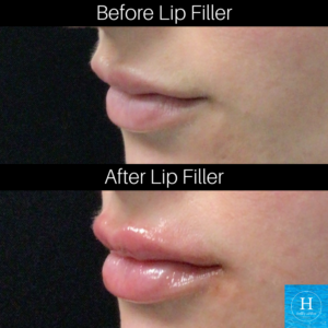 lip filler injections bucks county pa warminster pa