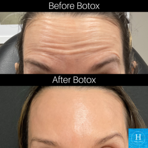 botox doylestown