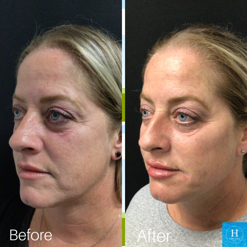 Before & After Filler Healthy Solutions Medspa