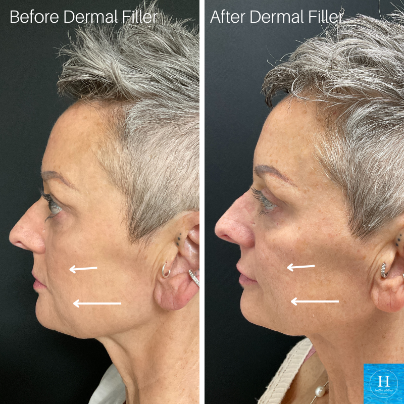 Before & After Filler Healthy Solutions Medspa