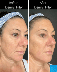dermal filler before and after