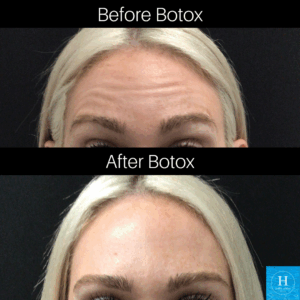 Best Botox place near me Doylestown Warminster Healthy Solutions Medspa