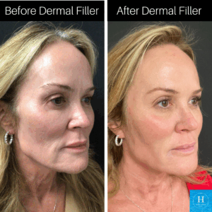 Cheek Filler Juvederm Voluma at Healthy Solutions Medspa doylestown Warminster
