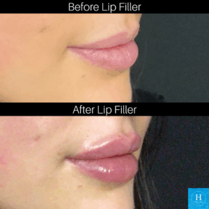 best lip filler near me doylestown warminster