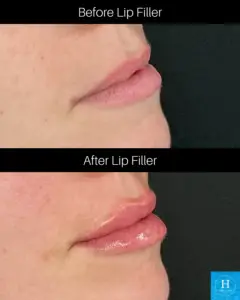 lip filler before and after