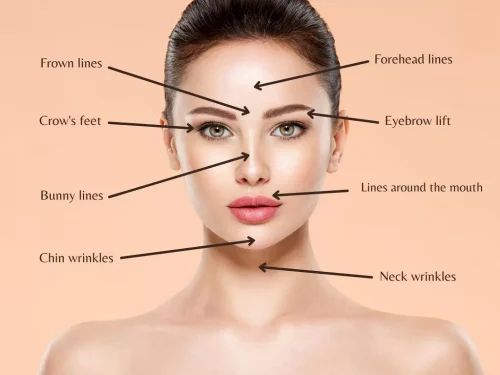 botox